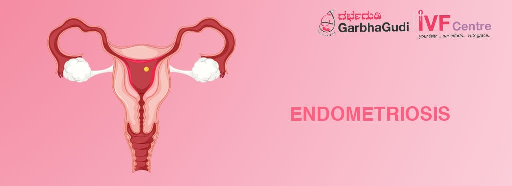 Endometriosis: Symptoms, Causes & Treatment Options