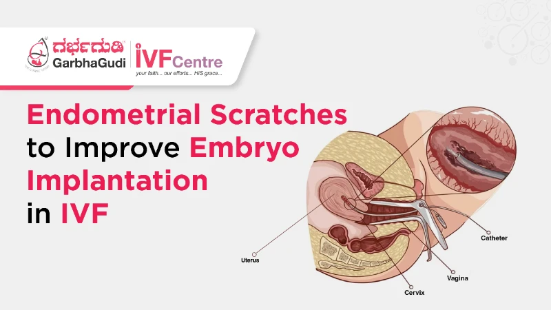 Does Endometrial Scratching Improve IVF Implantation?