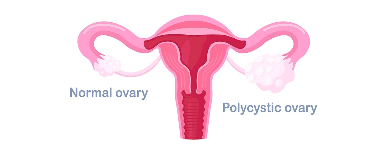 Polycystic Ovarian Syndrome (PCOS)