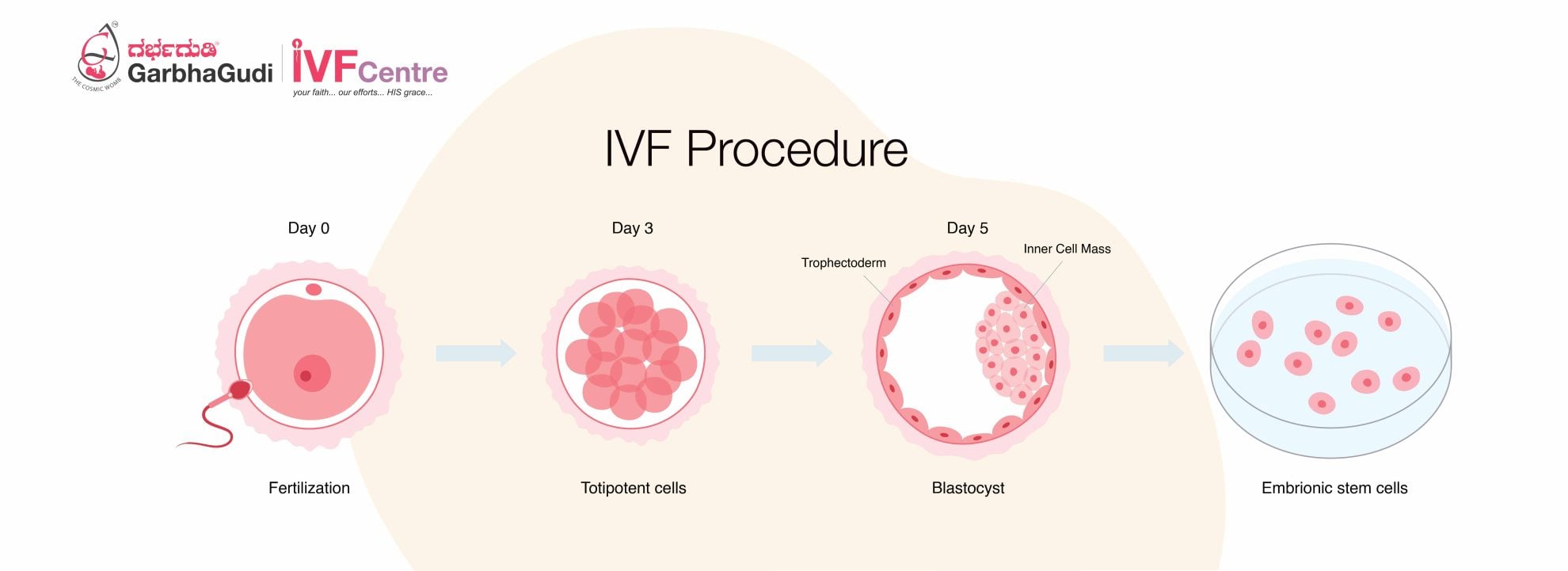IVF - Procedure
